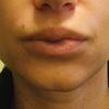 Tratamientos para granuloma en los labios por ácido hialurónico encapsulado - 46970