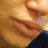 Tratamientos para granuloma en los labios por ácido hialurónico encapsulado - 46971