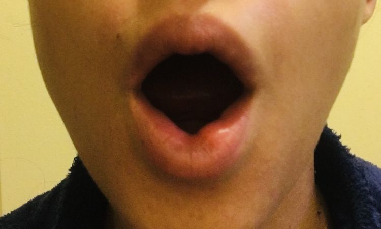 Tratamientos para granuloma en los labios por ácido hialurónico encapsulado - 46972