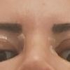 Blefaroplastia en ojo con leve ptosis - 46983