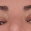 Blefaroplastia en ojo con leve ptosis - 46984