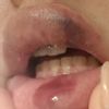 Posible necrosis tras aumento de labios - 47022