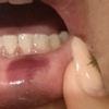 Posible necrosis tras aumento de labios - 47023