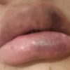 Posible necrosis tras aumento de labios - 47024