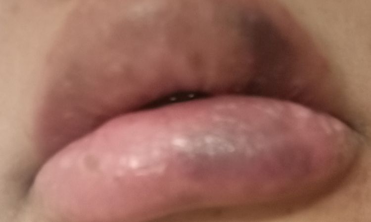 Posible necrosis tras aumento de labios - 47024