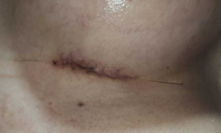 Arañas vasculares en cicatriz tras aumento de pecho - 47028