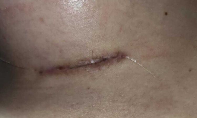 Arañas vasculares en cicatriz tras aumento de pecho - 47029