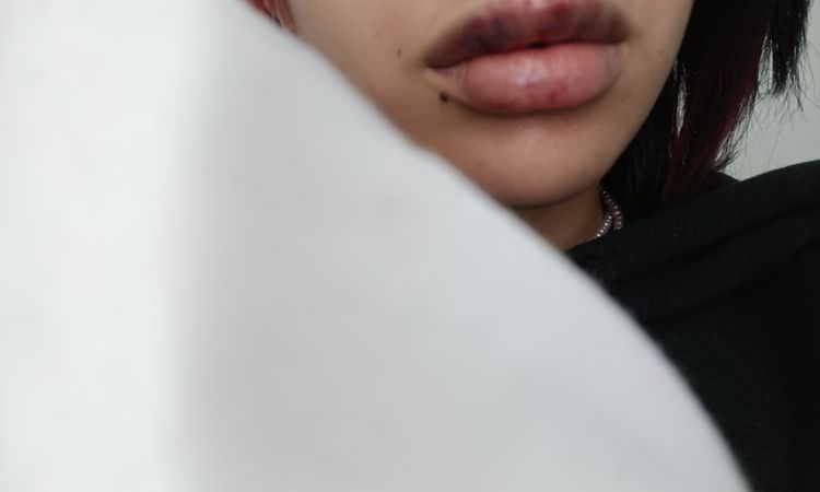 Posible reacción tras aumento de labios - 47030