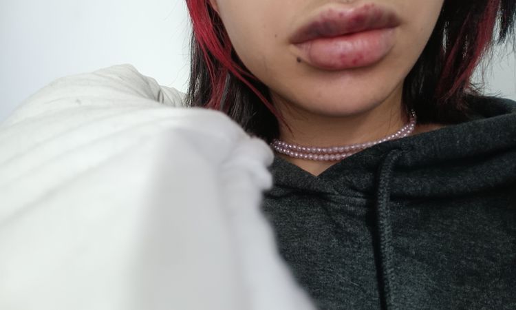 Posible reacción tras aumento de labios - 47031