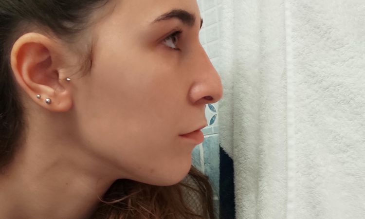 Levantamiento de punta de nariz caída con injerto - 47042