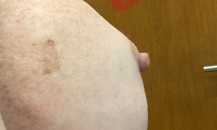 Retracción en areolas tras cambio de prótesis mamarias - 47301