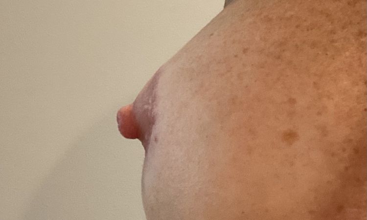 Retracción en areolas tras cambio de prótesis mamarias - 47303