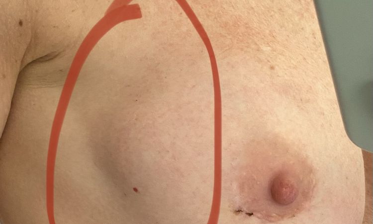 Retracción en areolas tras cambio de prótesis mamarias - 47305