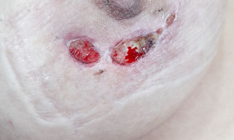 Seromas oscuros y heridas que no cierran post aumento de pecho - 47409