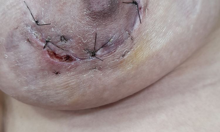 Seromas oscuros y heridas que no cierran post aumento de pecho - 47410
