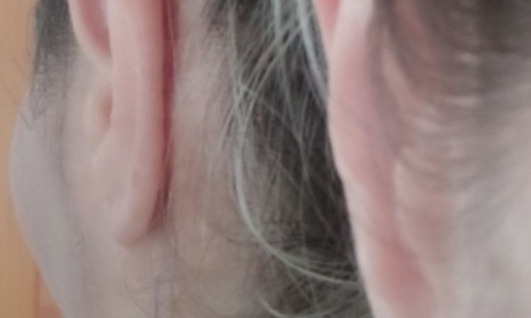 Oreja muy pegada tras 10 meses de otoplastia. ¿Cómo separar? - 47438