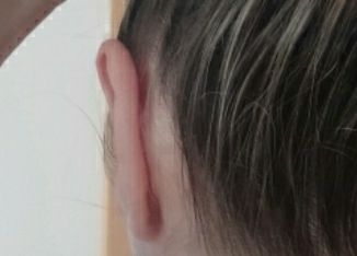 Oreja muy pegada tras 10 meses de otoplastia. ¿Cómo separar? - 47439