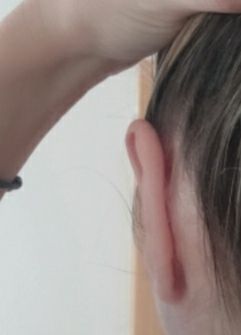 Oreja muy pegada tras 10 meses de otoplastia. ¿Cómo separar? - 47440