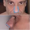 Rinoplastia en nariz globulosa - 47471