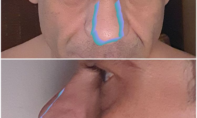 Rinoplastia en nariz globulosa - 47471