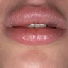 Asimetría tras aumento de labios con ácido hialuronico - 47476