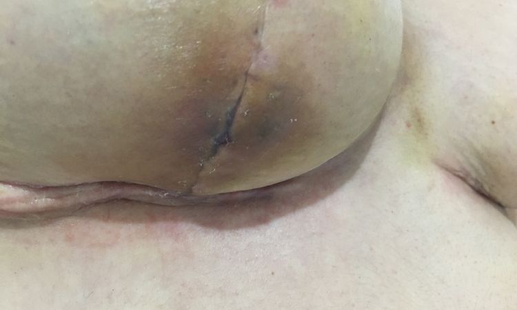 Hematoma drenando solo tras reducción de mamas - 47498