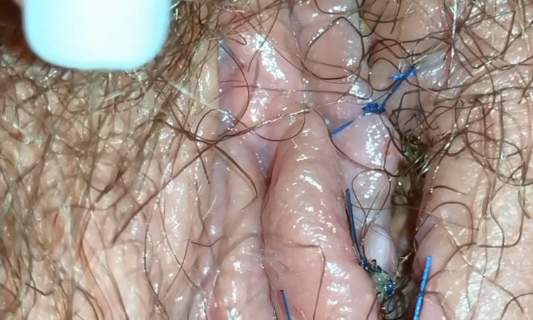 Hueco tras retirar sutura de labioplastia - 47609