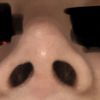 Punta de nariz alta post-rinoplastia 3 meses