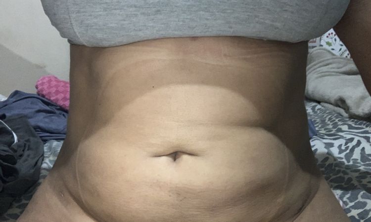 Se puede hacer liposonix tras cirugía de liposucción? - 48001