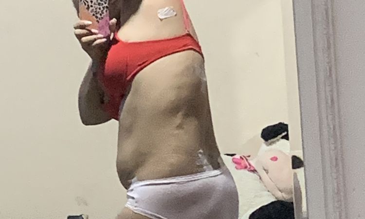 Se puede hacer liposonix tras cirugía de liposucción? - 48002