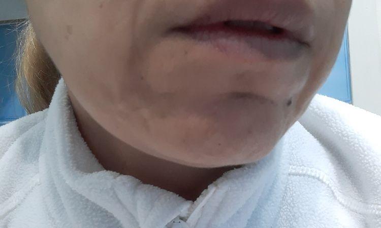 Eliminar cicatriz deprimida muy notoria en labio superior - 48064