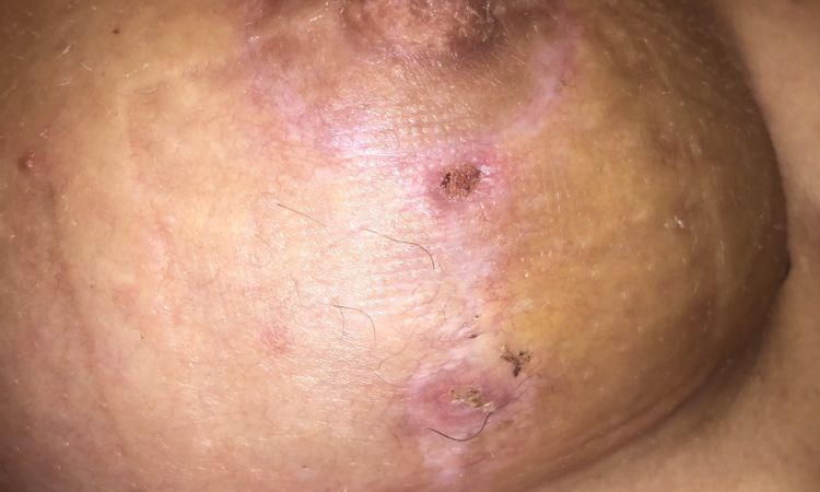 Cicatriz abierta tras 51 días operada de mastopexia de reducción - 48076