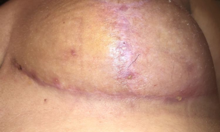Cicatriz abierta tras 51 días operada de mastopexia de reducción - 48077