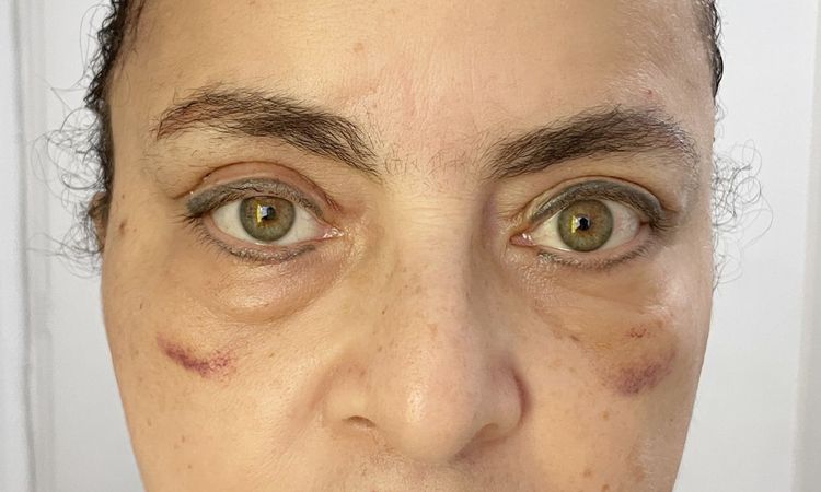 Es normal la asimetría en una blefaroplastia? - 48137