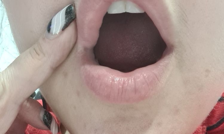 Bultos tras aumento de labios con Juvéderm hace 1 mes - 48228