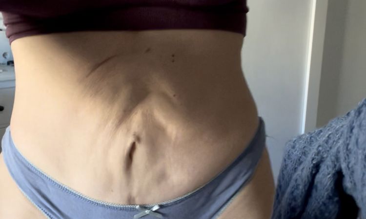 Retoque en abdominoplastia mal hecha - 48281