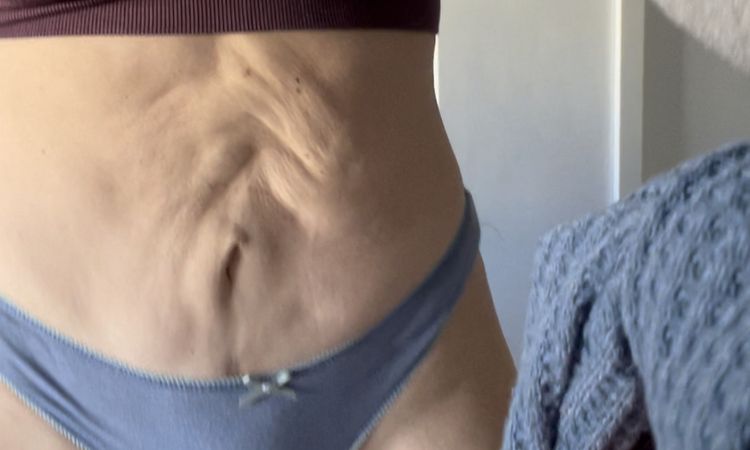 Retoque en abdominoplastia mal hecha - 48282