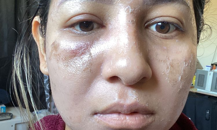 Quemadura en rostro tras peeling - 48430
