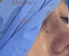 Consulta sobre puntos visibles en septorinoplastia - 48575