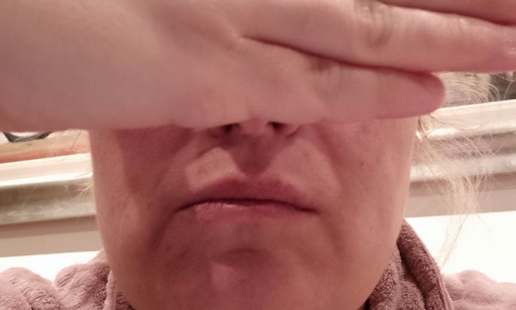 Juvederm, Radiesse o Belotero - 48639
