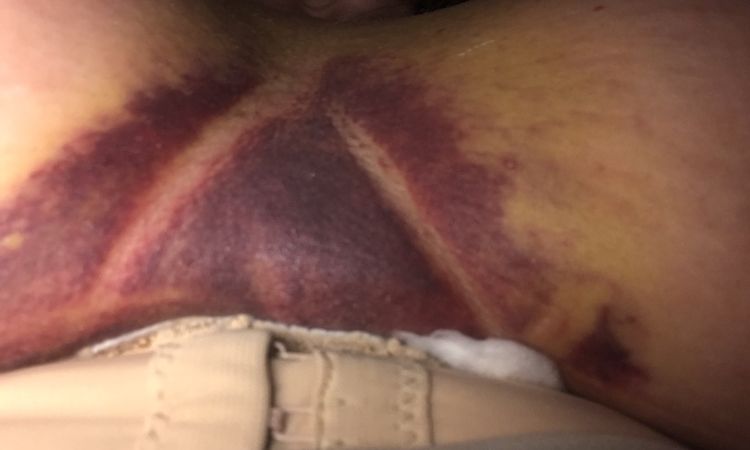 Hematoma entre los pechos tras operación - 48646