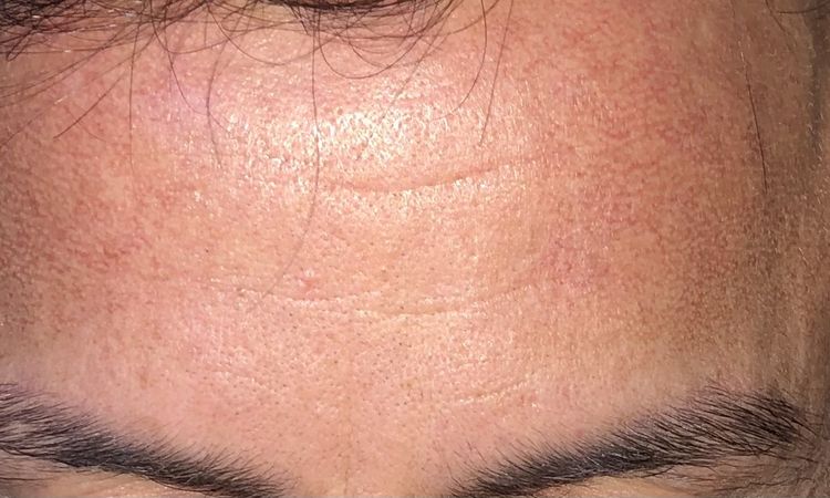 Tratamiento para Poiquilodermia facial. - 48678