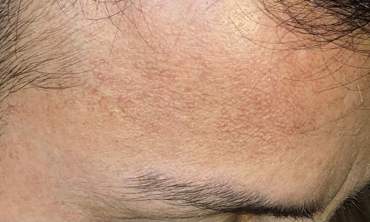 Tratamiento para Poiquilodermia facial. - 48679