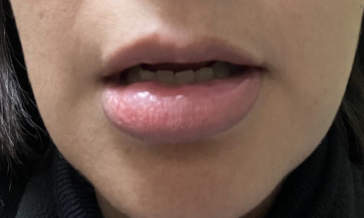 Bolas de ácido hialurónico en labios que no se van con hialuronidasa - 48891