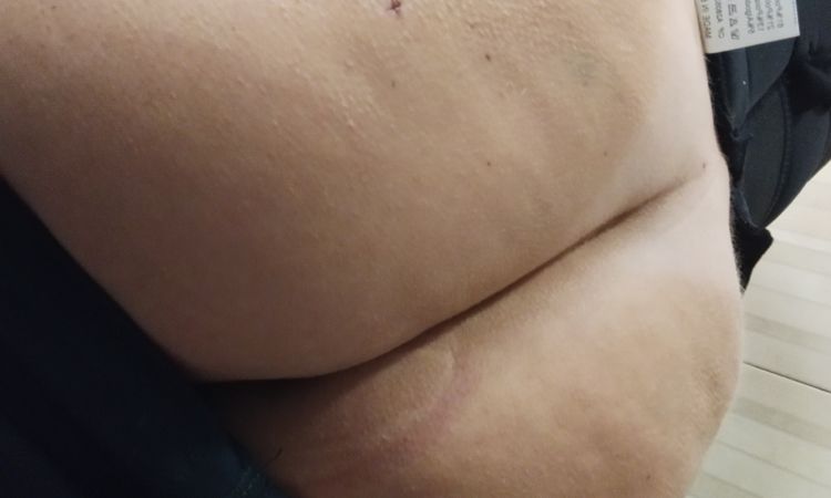 Culo con deformidades tras Lipo vaser con transferencia a glúteos - 48956