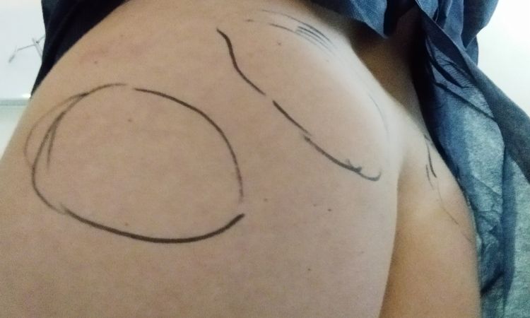 Culo con deformidades tras Lipo vaser con transferencia a glúteos - 48957