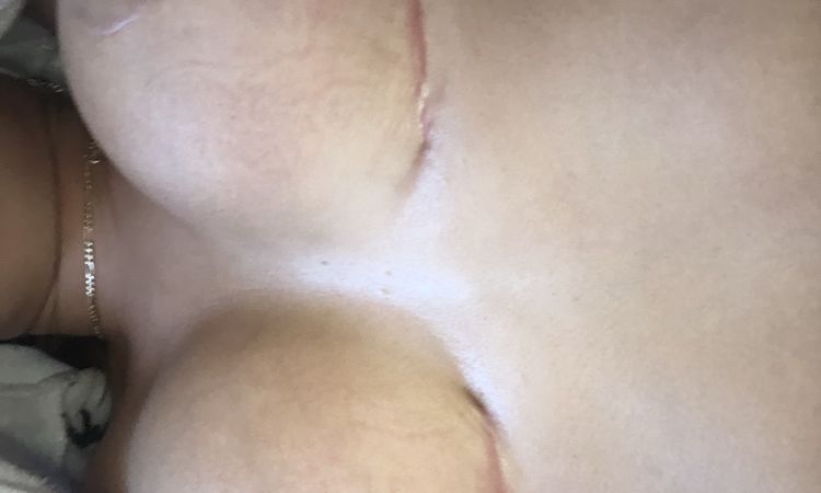 Pliegue en la cicatriz de mastopexia - 49020