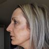 Asimetría facial tras poner hilos espiculados - 49467
