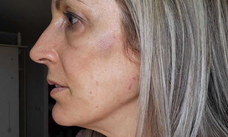 Asimetría facial tras poner hilos espiculados - 49467