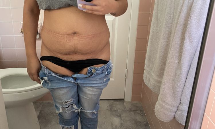 Abdominoplastia y el bbl el mismo día? - 49683